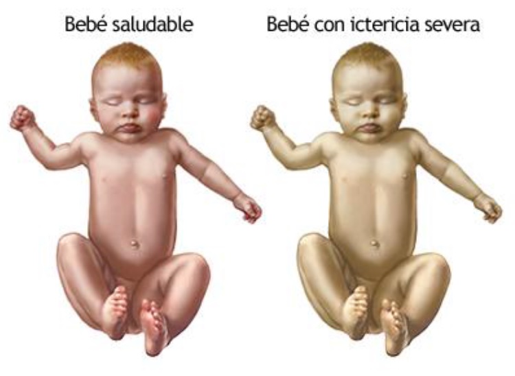 ictericia